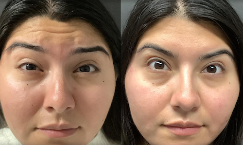 Lines Smooth Neurotoxin Before After Mississauga